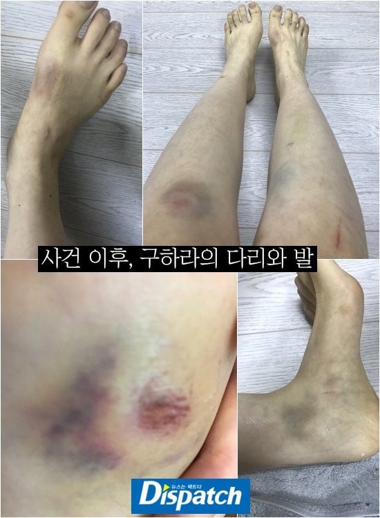Luka memar di tubuh Goo Hara