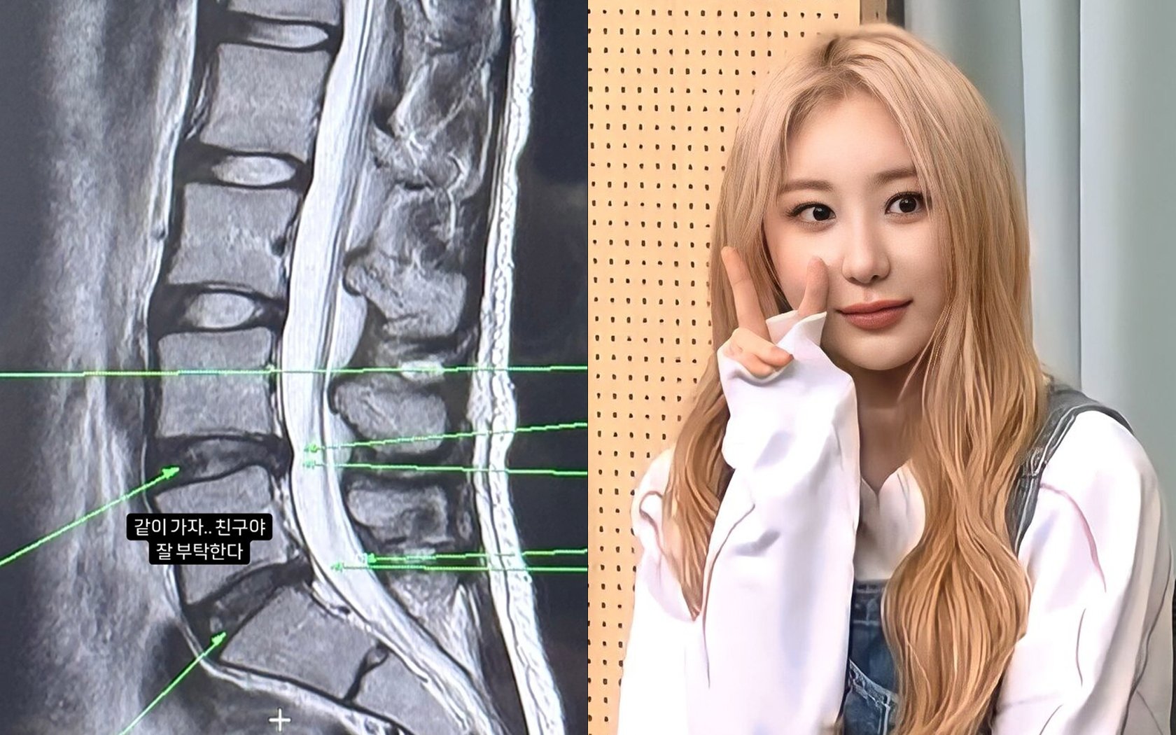 Lee Chae Yeon mengungkapkan dia harus menghentikan sementara aktivitas menarinya