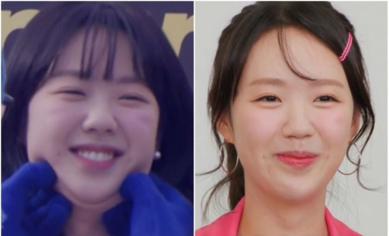 Dagu ganda Ji Ye Eun menghilang setelah ultherapy saat cast “running man” bereaksi